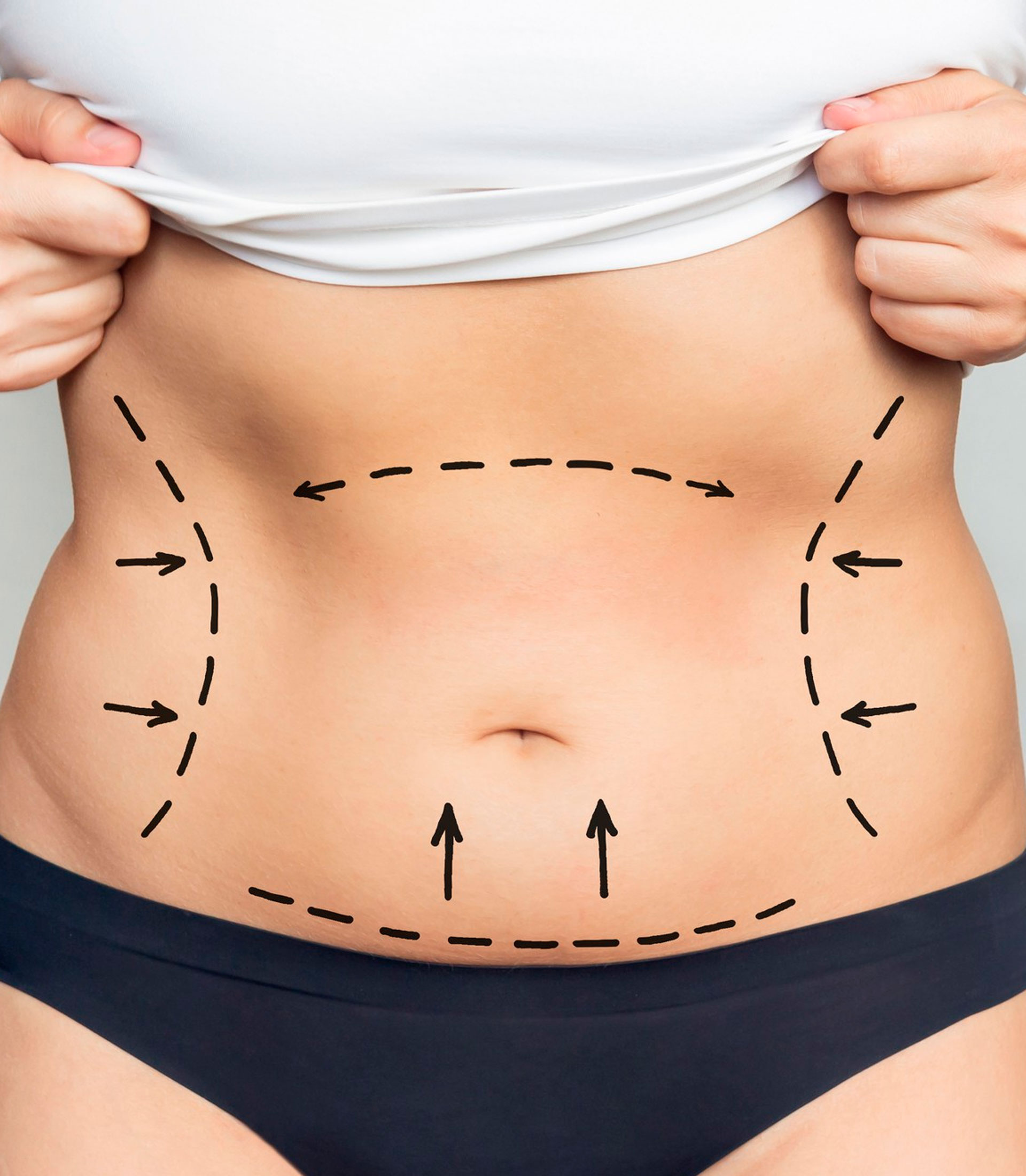 Mini Redução de Abdomem (Miniabdominoplastia)